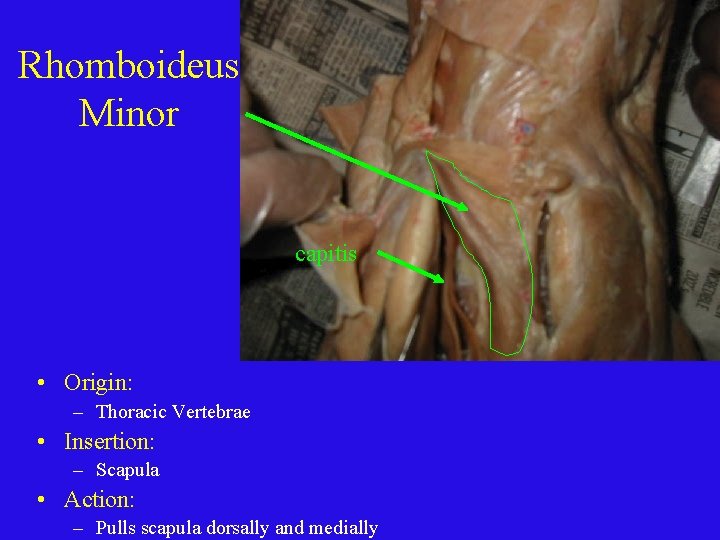 Rhomboideus Minor capitis • Origin: – Thoracic Vertebrae • Insertion: – Scapula • Action: