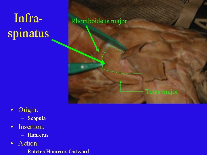 Infraspinatus Rhomboideus major Teres major • Origin: – Scapula • Insertion: – Humerus •