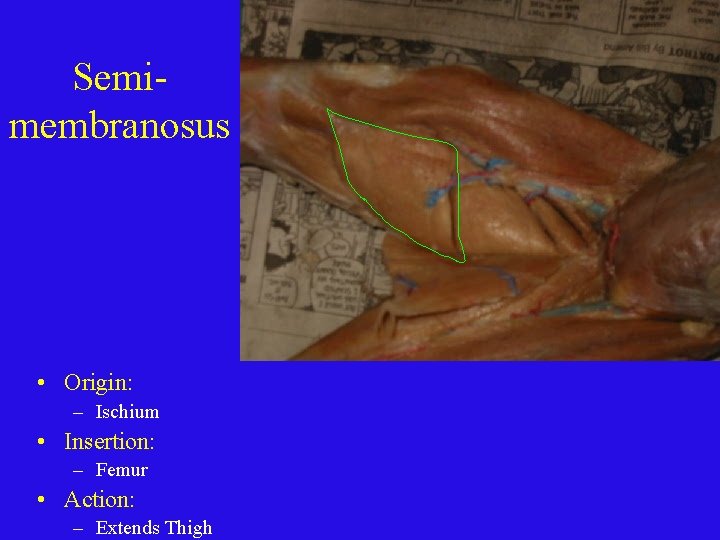 Semimembranosus • Origin: – Ischium • Insertion: – Femur • Action: – Extends Thigh