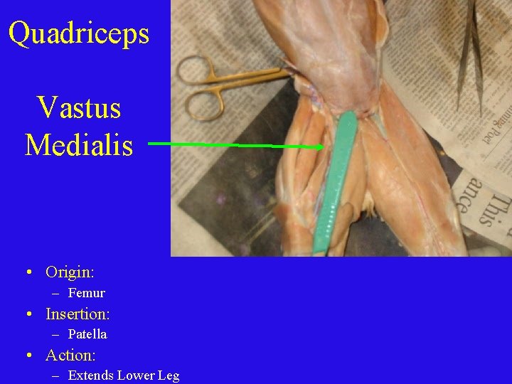 Quadriceps Vastus Medialis • Origin: – Femur • Insertion: – Patella • Action: –