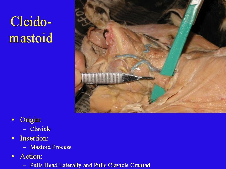 Cleidomastoid • Origin: – Clavicle • Insertion: – Mastoid Process • Action: – Pulls