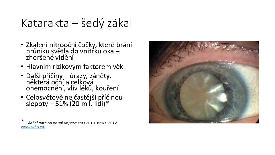 Katarakta – šedý zákal • Zkalení nitrooční čočky, které brání průniku světla do vnitřku