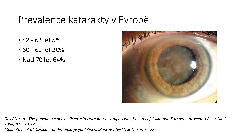 Prevalence katarakty v Evropě • 52 - 62 let 5% • 60 - 69