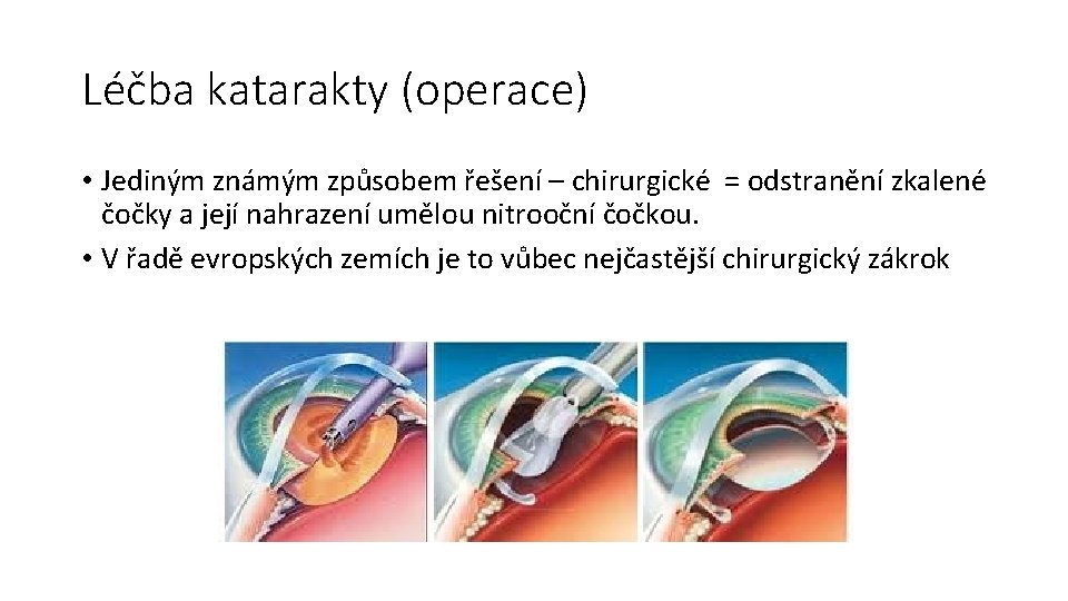 Léčba katarakty (operace) • Jediným známým způsobem řešení – chirurgické = odstranění zkalené čočky