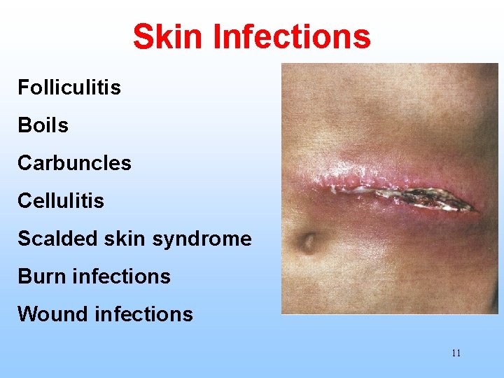 Skin Infections Folliculitis Boils Carbuncles Cellulitis Scalded skin syndrome Burn infections Wound infections 11