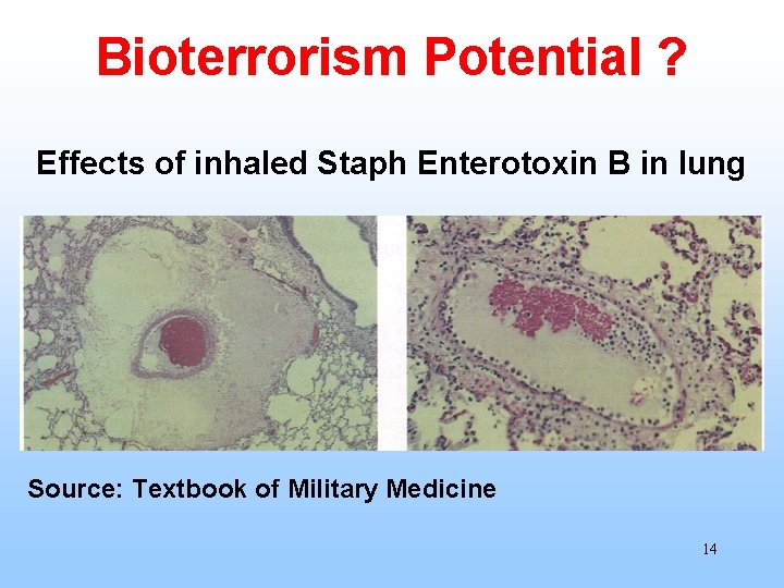 Bioterrorism Potential ? Effects of inhaled Staph Enterotoxin B in lung Source: Textbook of