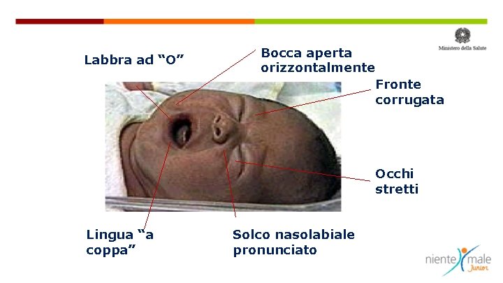 Labbra ad “O” Bocca aperta orizzontalmente Fronte corrugata Occhi stretti Lingua “a coppa” Solco