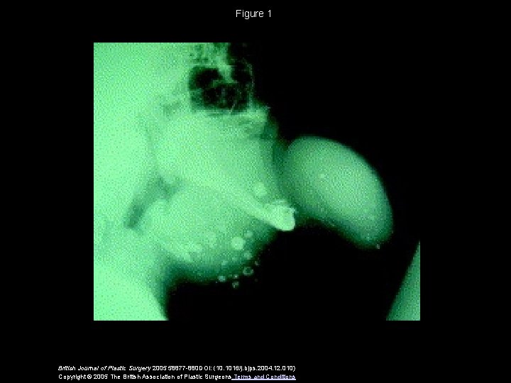 Figure 1 British Journal of Plastic Surgery 2005 58877 -880 DOI: (10. 1016/j. bjps.