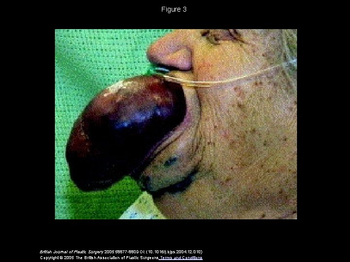 Figure 3 British Journal of Plastic Surgery 2005 58877 -880 DOI: (10. 1016/j. bjps.