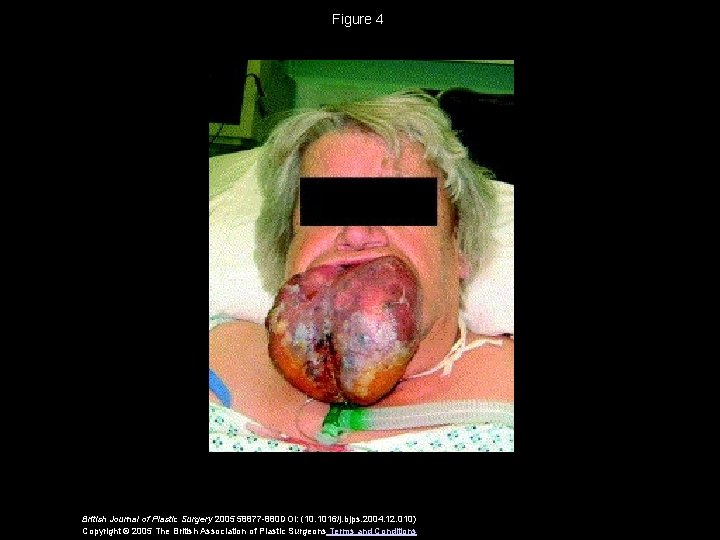 Figure 4 British Journal of Plastic Surgery 2005 58877 -880 DOI: (10. 1016/j. bjps.