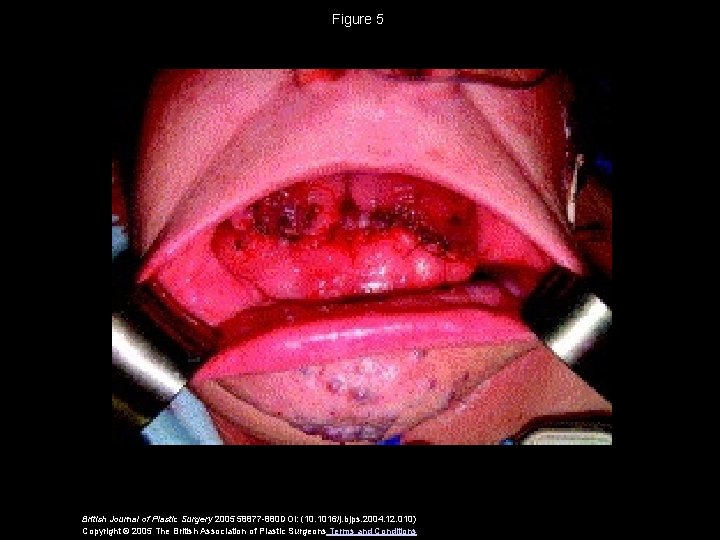 Figure 5 British Journal of Plastic Surgery 2005 58877 -880 DOI: (10. 1016/j. bjps.