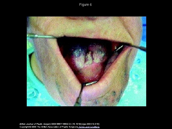 Figure 6 British Journal of Plastic Surgery 2005 58877 -880 DOI: (10. 1016/j. bjps.