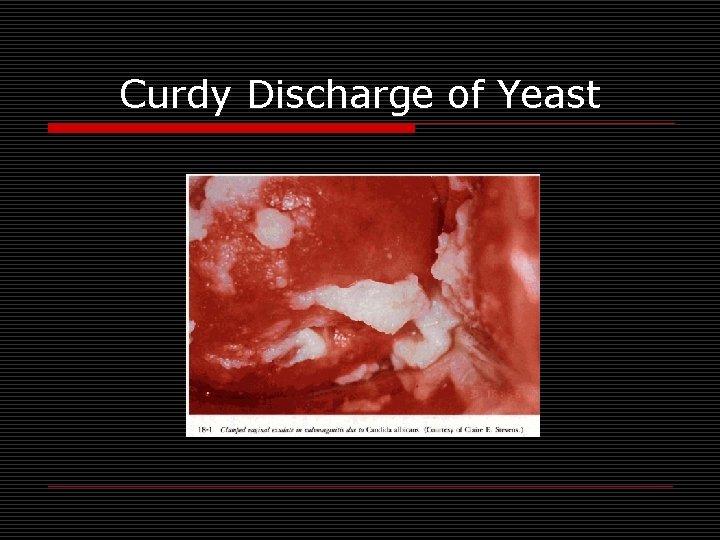 Curdy Discharge of Yeast 
