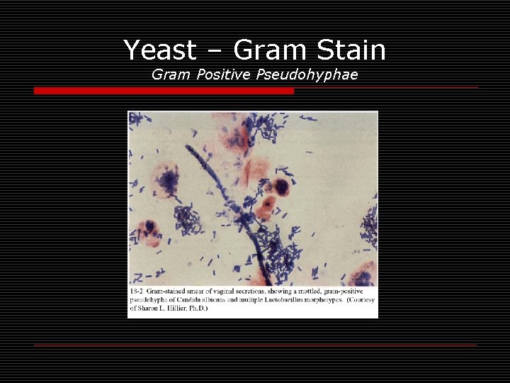 Yeast – Gram Stain Gram Positive Pseudohyphae 