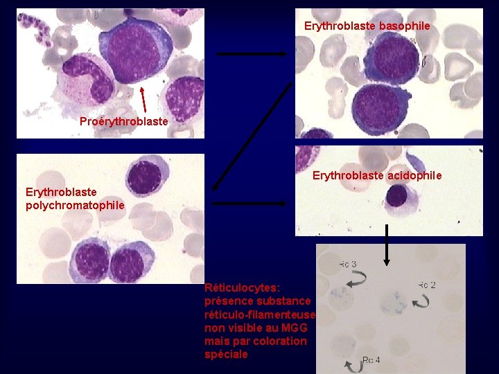 Erythroblaste basophile Proérythroblaste Erythroblaste acidophile Erythroblaste polychromatophile Réticulocytes: présence substance réticulo-filamenteuse non visible au