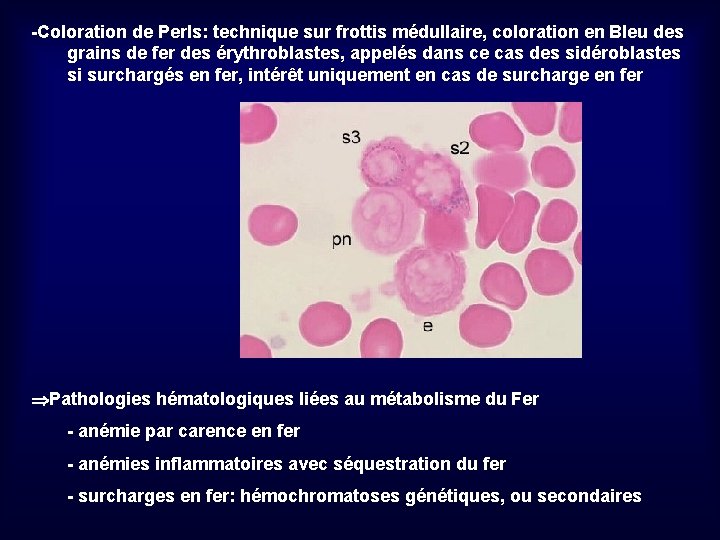 -Coloration de Perls: technique sur frottis médullaire, coloration en Bleu des grains de fer