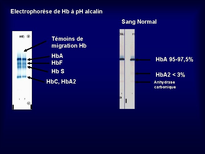 Electrophorèse de Hb à p. H alcalin Sang Normal Témoins de migration Hb Hb.