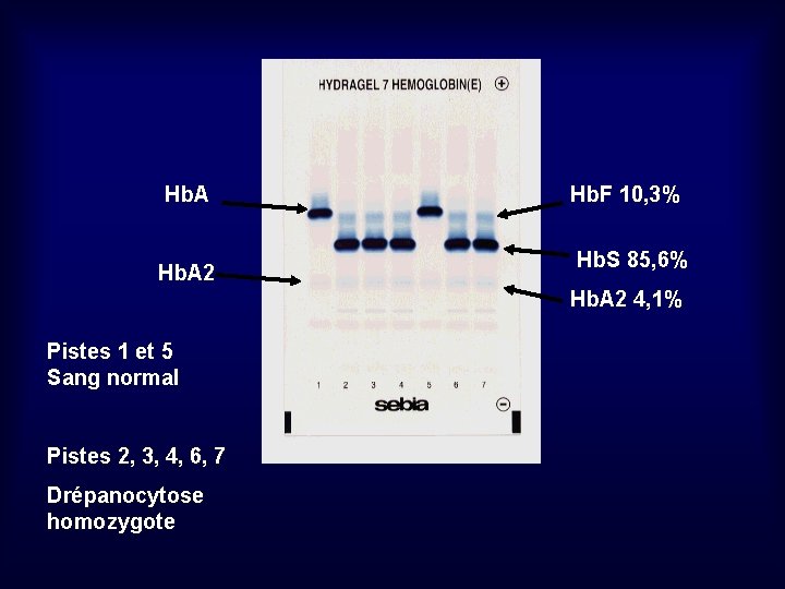 Hb. A 2 Hb. F 10, 3% Hb. S 85, 6% Hb. A 2