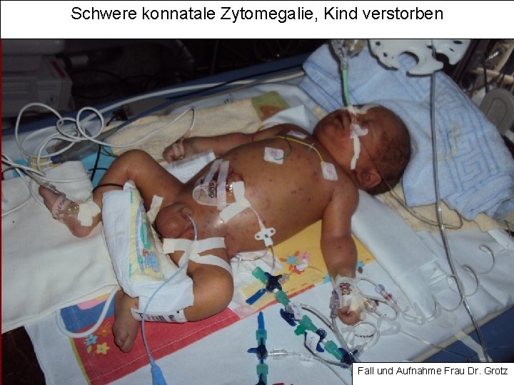 Schwere konnatale Zytomegalie, Kind verstorben Fall und Aufnahme Frau Dr. Grotz 