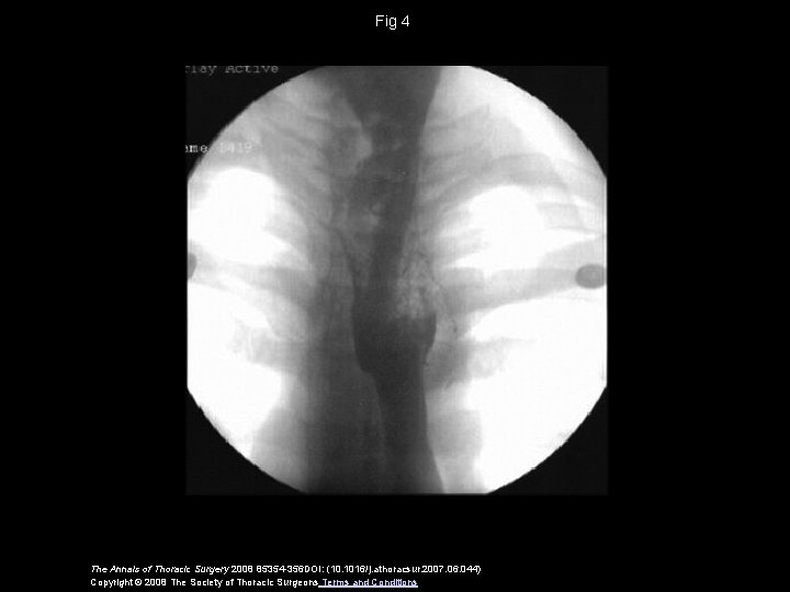 Fig 4 The Annals of Thoracic Surgery 2008 85354 -356 DOI: (10. 1016/j. athoracsur.