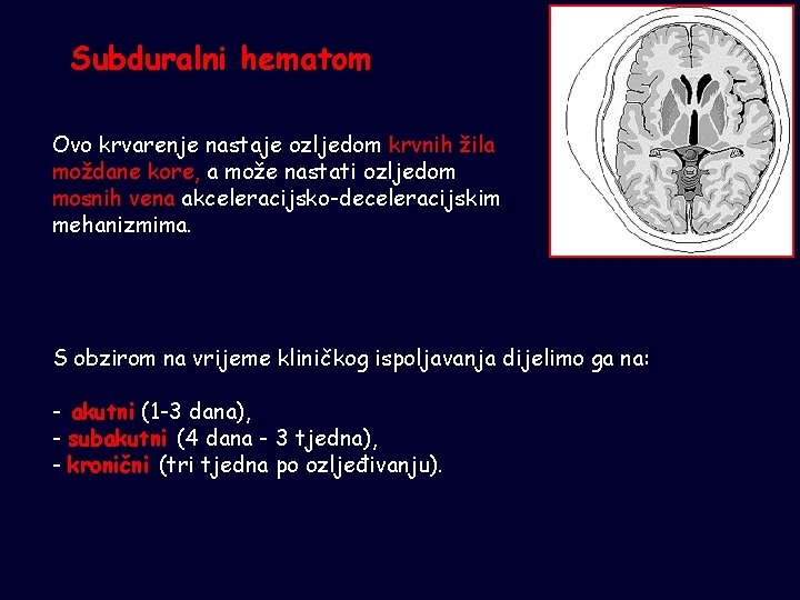 Subduralni hematom Ovo krvarenje nastaje ozljedom krvnih žila moždane kore, a može nastati ozljedom