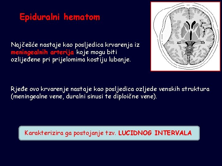 Epiduralni hematom Najčešće nastaje kao posljedica krvarenja iz meningealnih arterija koje mogu biti ozlijeđene