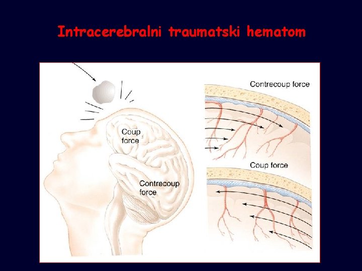 Intracerebralni traumatski hematom 