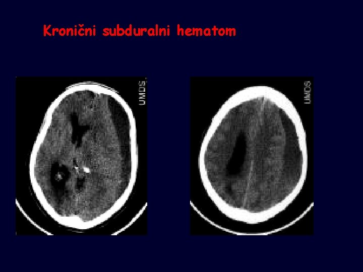 Kronični subduralni hematom 