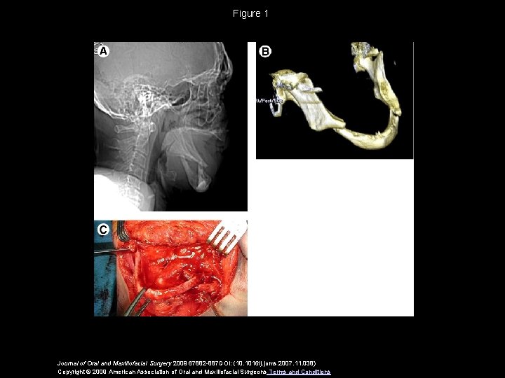 Figure 1 Journal of Oral and Maxillofacial Surgery 2009 67882 -887 DOI: (10. 1016/j.