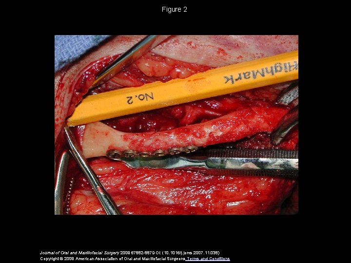 Figure 2 Journal of Oral and Maxillofacial Surgery 2009 67882 -887 DOI: (10. 1016/j.