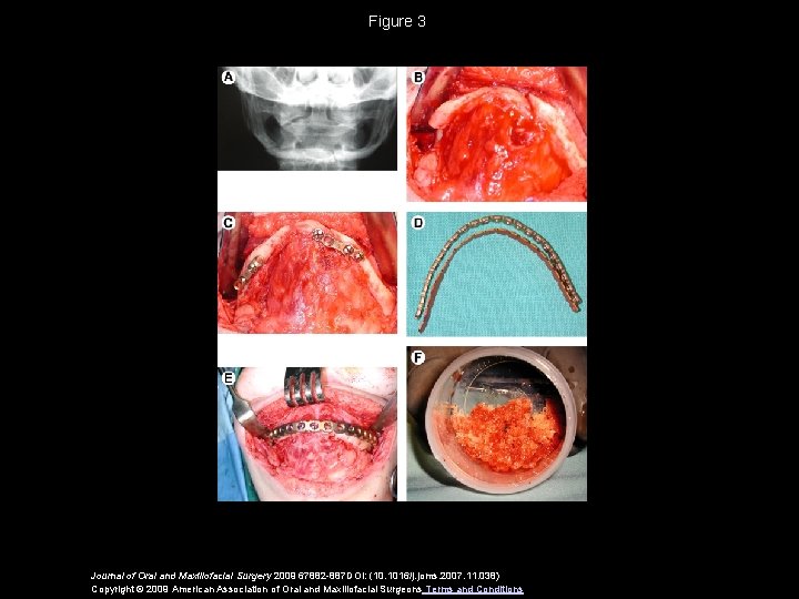 Figure 3 Journal of Oral and Maxillofacial Surgery 2009 67882 -887 DOI: (10. 1016/j.