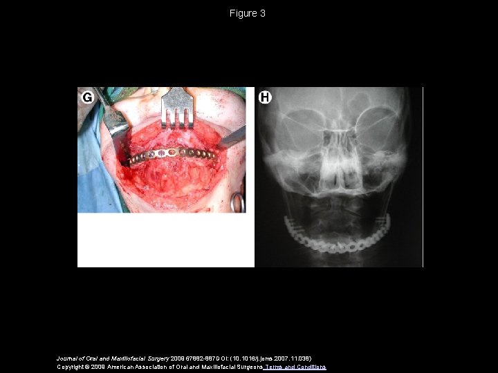 Figure 3 Journal of Oral and Maxillofacial Surgery 2009 67882 -887 DOI: (10. 1016/j.