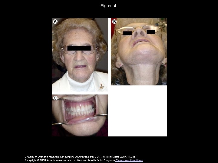 Figure 4 Journal of Oral and Maxillofacial Surgery 2009 67882 -887 DOI: (10. 1016/j.