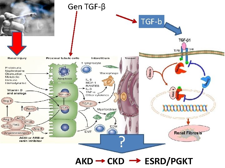 Gen TGF-β TGF-b ? AKD CKD ESRD/PGKT 