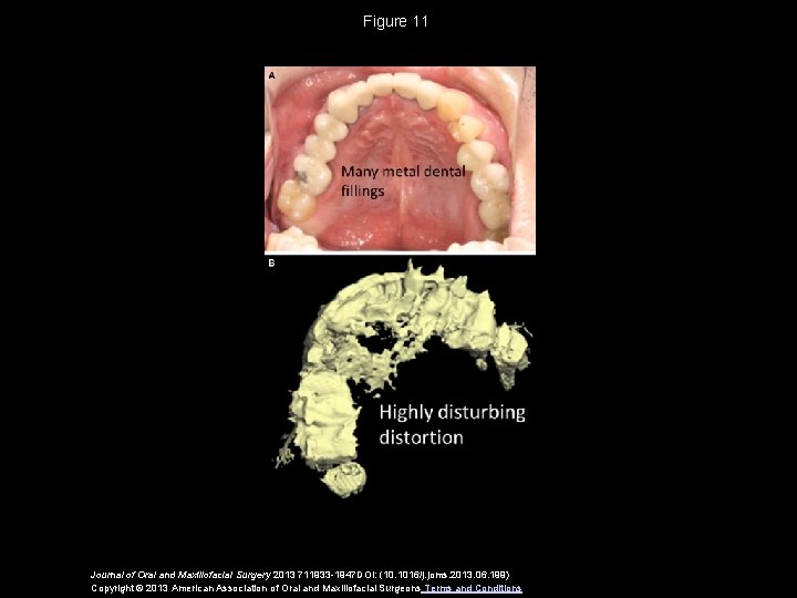 Figure 11 Journal of Oral and Maxillofacial Surgery 2013 711933 -1947 DOI: (10. 1016/j.