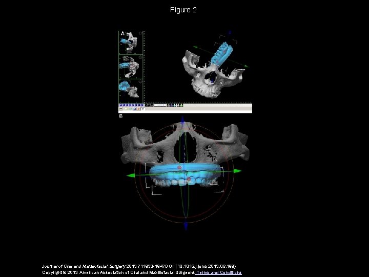 Figure 2 Journal of Oral and Maxillofacial Surgery 2013 711933 -1947 DOI: (10. 1016/j.