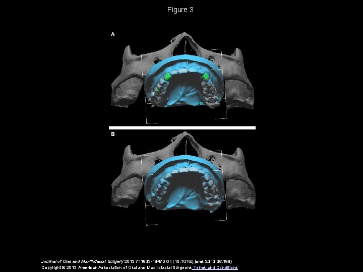 Figure 3 Journal of Oral and Maxillofacial Surgery 2013 711933 -1947 DOI: (10. 1016/j.