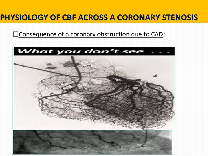 PHYSIOLOGY OF CBF ACROSS A CORONARY STENOSIS �Consequence of a coronary obstruction due to PHYSIOLOGY OF CBF ACROSS A CORONARY STENOSIS �Consequence of a coronary obstruction due to