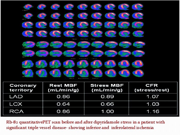 Rb-82 quantitative. PET scan before and after dipyridamole stress in a patient with significant Rb-82 quantitative. PET scan before and after dipyridamole stress in a patient with significant