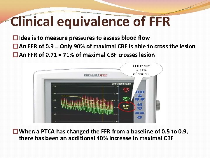 Clinical equivalence of FFR �Idea is to measure pressures to assess blood flow �An Clinical equivalence of FFR �Idea is to measure pressures to assess blood flow �An