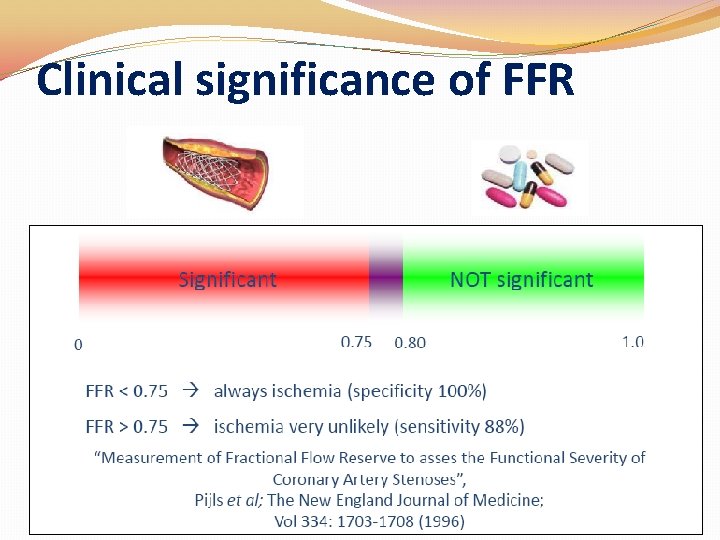 Clinical significance of FFR Clinical significance of FFR