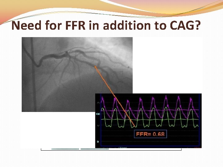 Need for FFR in addition to CAG? Need for FFR in addition to CAG?