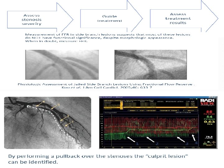 � Decision making for intermediate lesions � Decision regarding mutivessel PCI �Serial lesions �Diffuse � Decision making for intermediate lesions � Decision regarding mutivessel PCI �Serial lesions �Diffuse