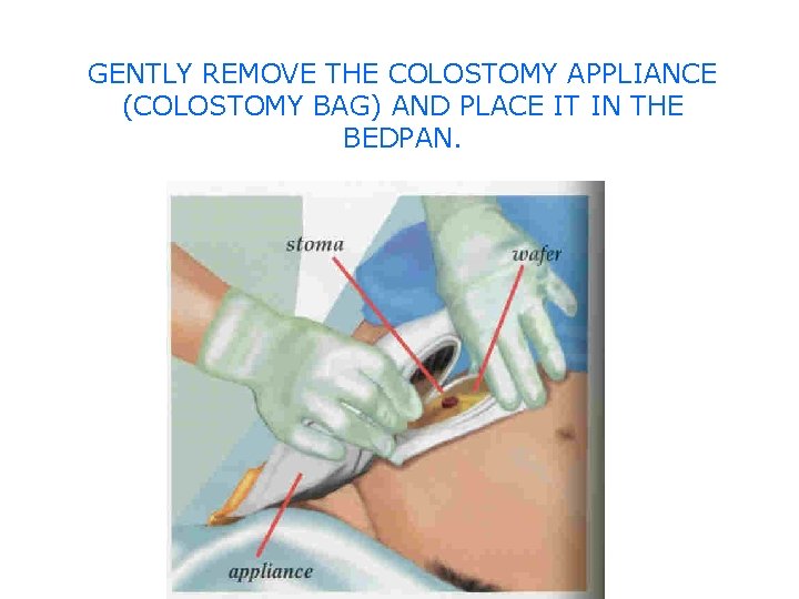 GENTLY REMOVE THE COLOSTOMY APPLIANCE (COLOSTOMY BAG) AND PLACE IT IN THE BEDPAN. 