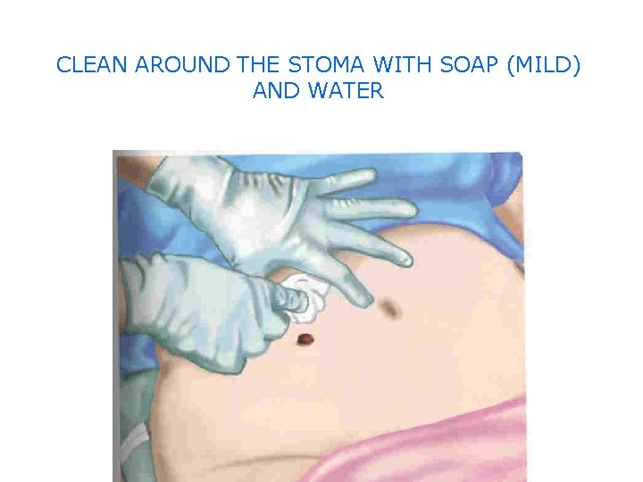 CLEAN AROUND THE STOMA WITH SOAP (MILD) AND WATER 