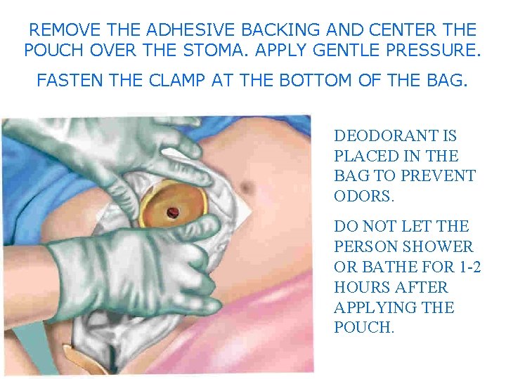 REMOVE THE ADHESIVE BACKING AND CENTER THE POUCH OVER THE STOMA. APPLY GENTLE PRESSURE.