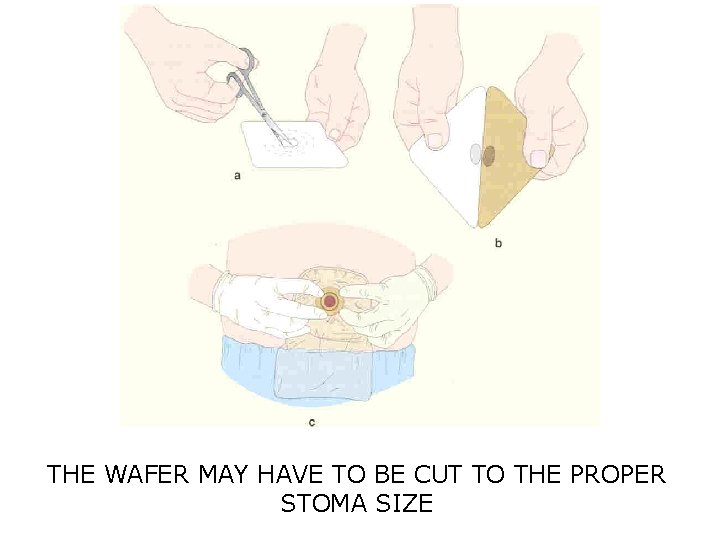 THE WAFER MAY HAVE TO BE CUT TO THE PROPER STOMA SIZE 