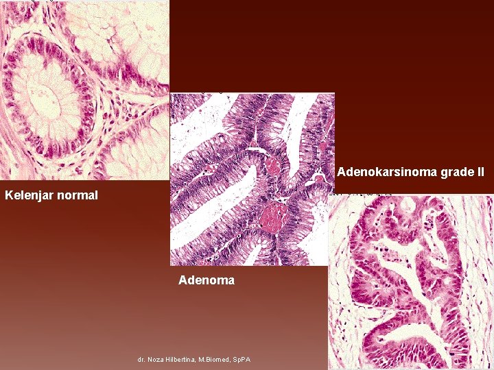 Adenokarsinoma grade II Kelenjar normal Adenoma dr. Noza Hilbertina, M. Biomed, Sp. PA 12