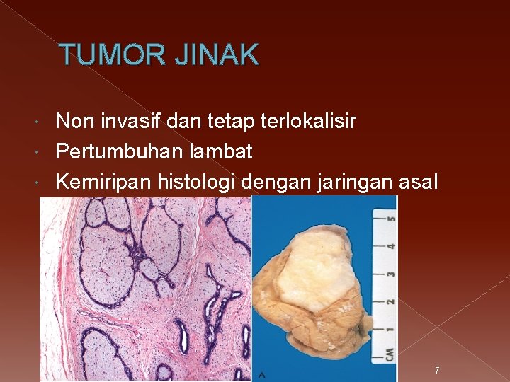 TUMOR JINAK Non invasif dan tetap terlokalisir Pertumbuhan lambat Kemiripan histologi dengan jaringan asal