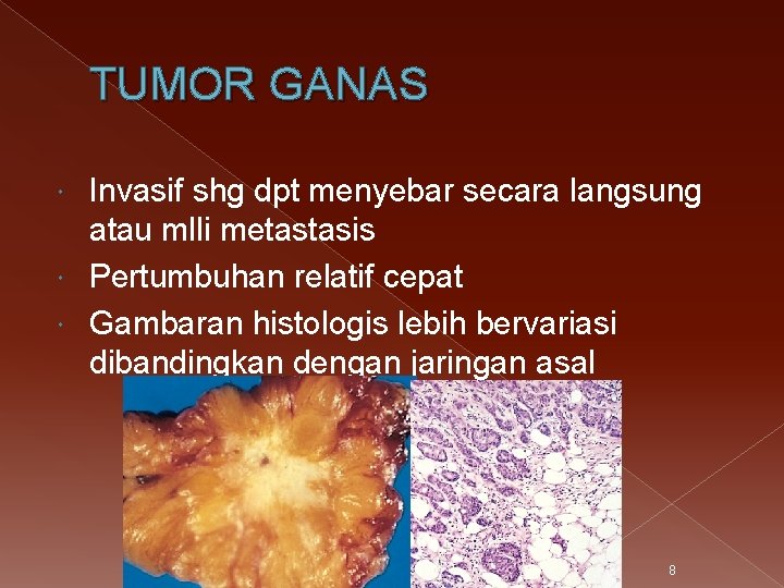 TUMOR GANAS Invasif shg dpt menyebar secara langsung atau mlli metastasis Pertumbuhan relatif cepat